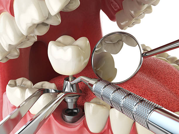 Best Emergency Wisdom Tooth Extraction in Melrose, MN